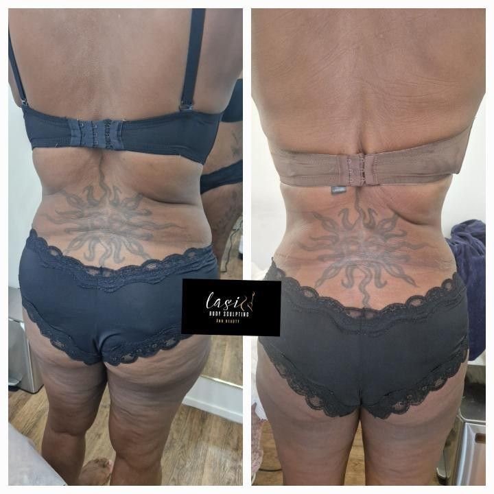 before and after mummy makeover bundle